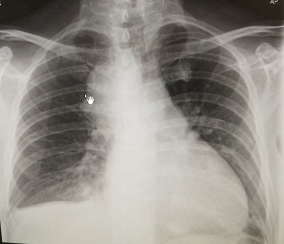 His chest X-ray (AP view) showed enlarged mediastinal lymph nodes, which were known.