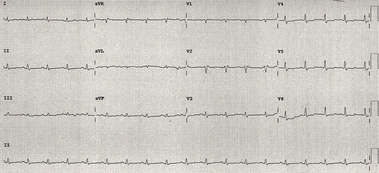 Then came the ECG — and the diagnosis.